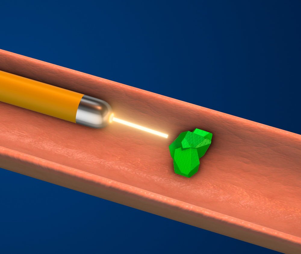 LITOTRICIA LASER THULIUM
