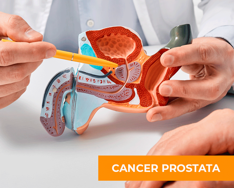 SINTOMAS DEL CANCER DE PROSTATA